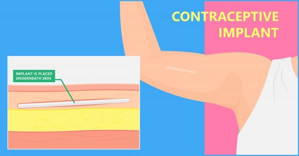 Contraceptive Implant, inserted under your skin