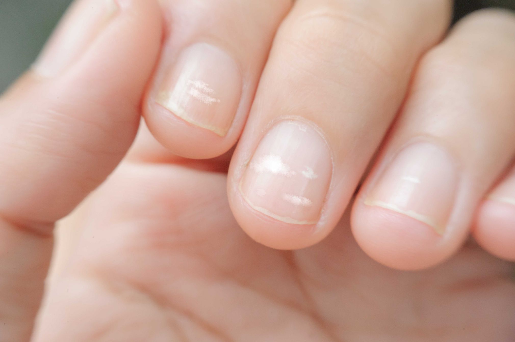 Iron deficiency may lead to brittle nails, due to the lack of nutrients.