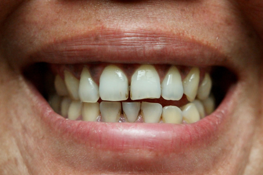 Stained teeth can be due to poor oral hygiene as well as food and lifestyle choices.