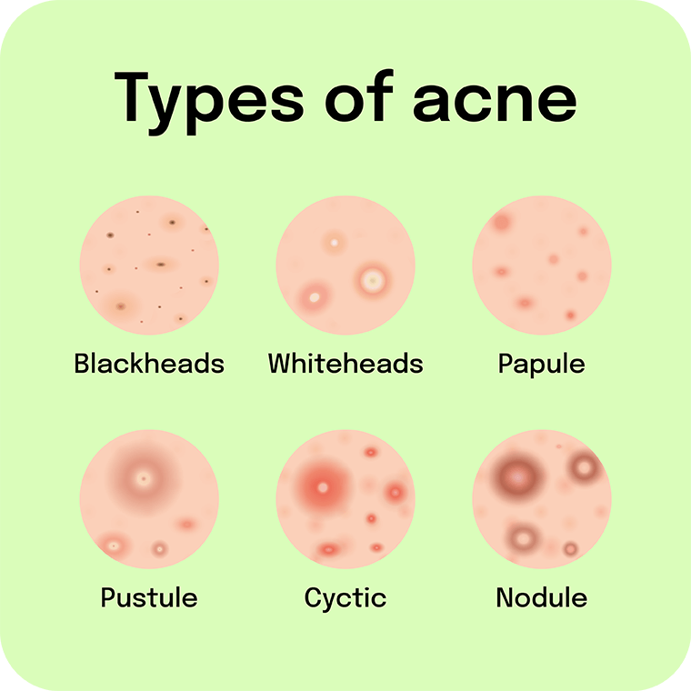 Women-Skin-acne-pimple-type