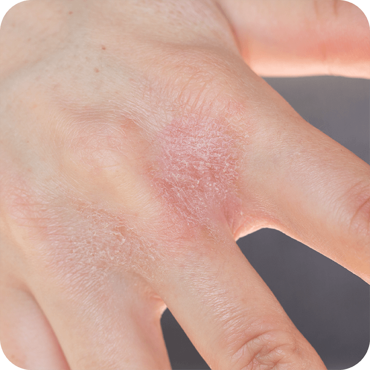 Women-Skin-hand-eczema-flare-up